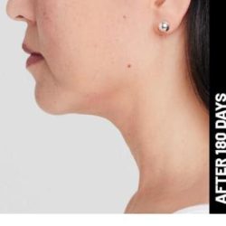 Ultherapy Before & After Patient #1546